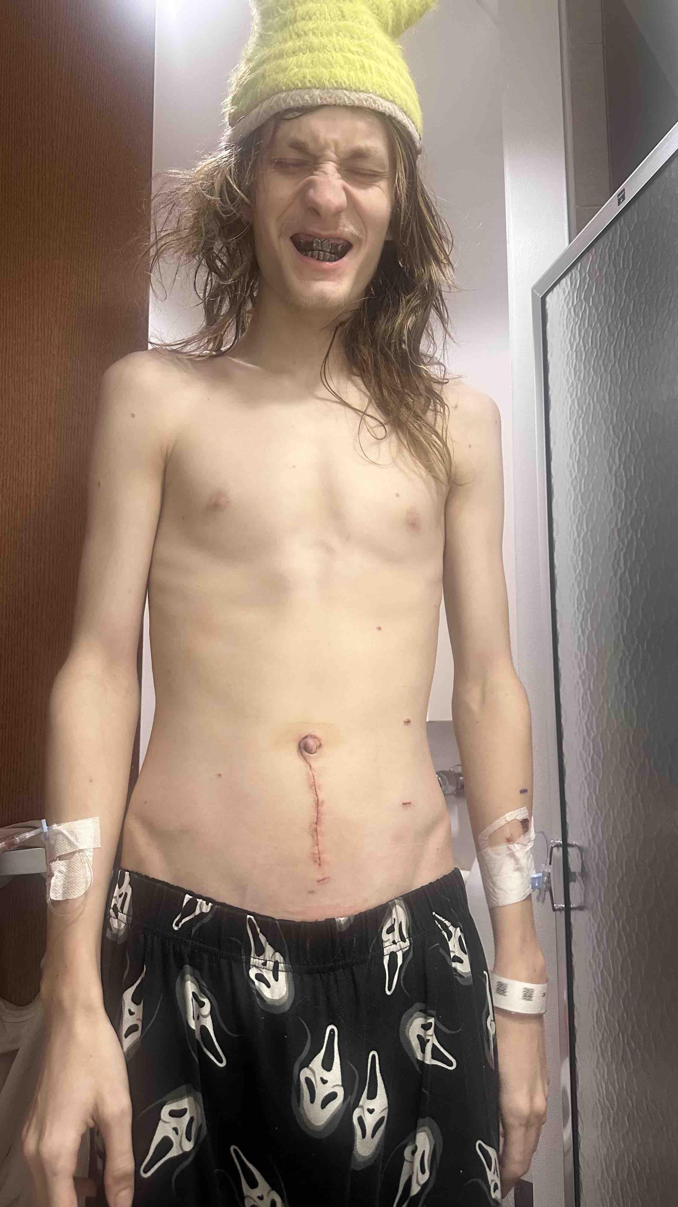 Malkolm in the hospital during recovery, standing and smiling despite bandages and a surgical scar